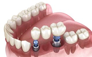 Multiple Tooth Implants