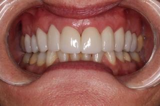 Dental Crowns 2 - After