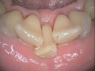 Dental Clean 2 - After