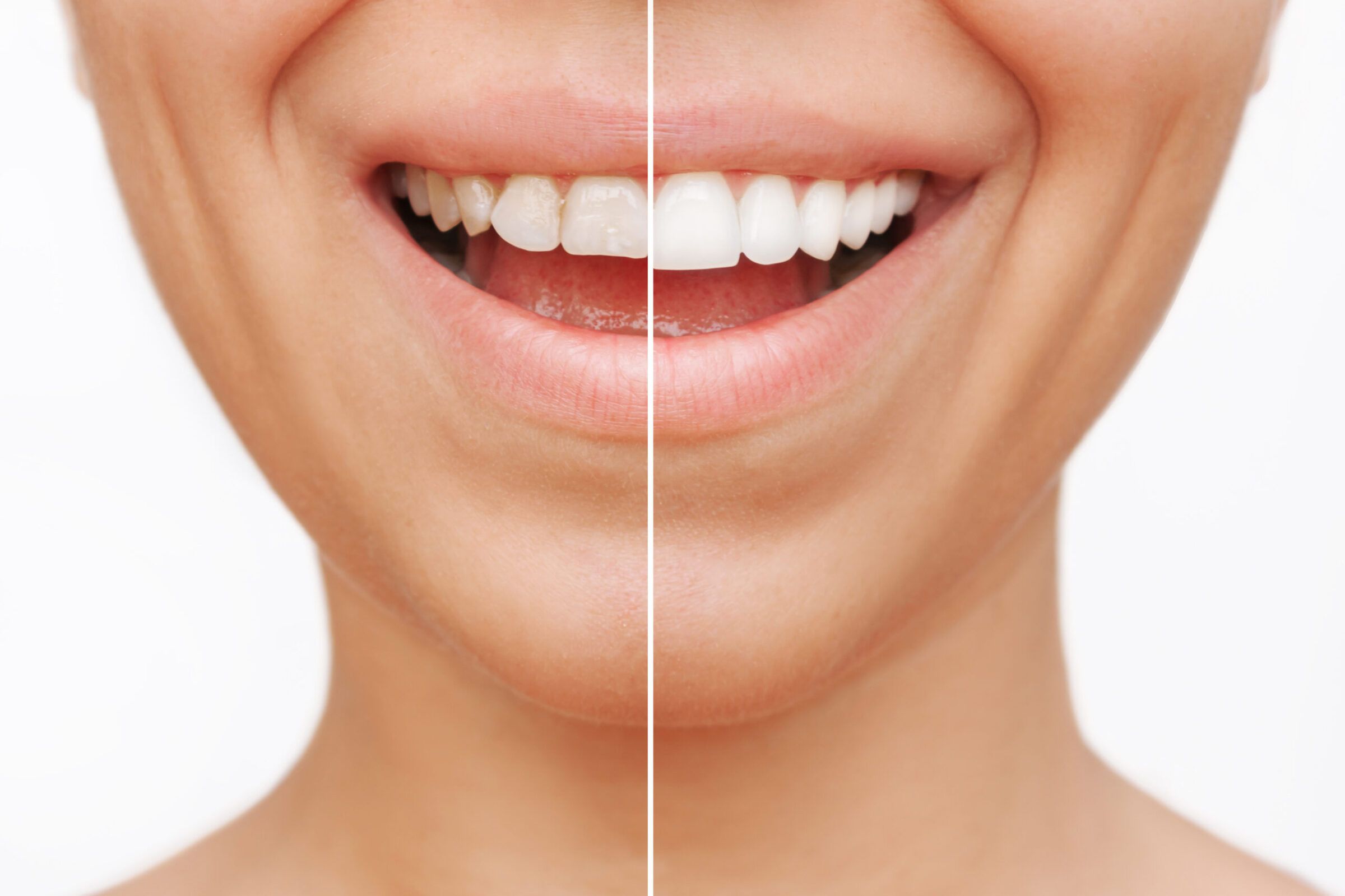 Are Veneers Bad for Your Teeth? - Hero
