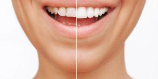 Are Veneers Bad for Your Teeth? - Hero