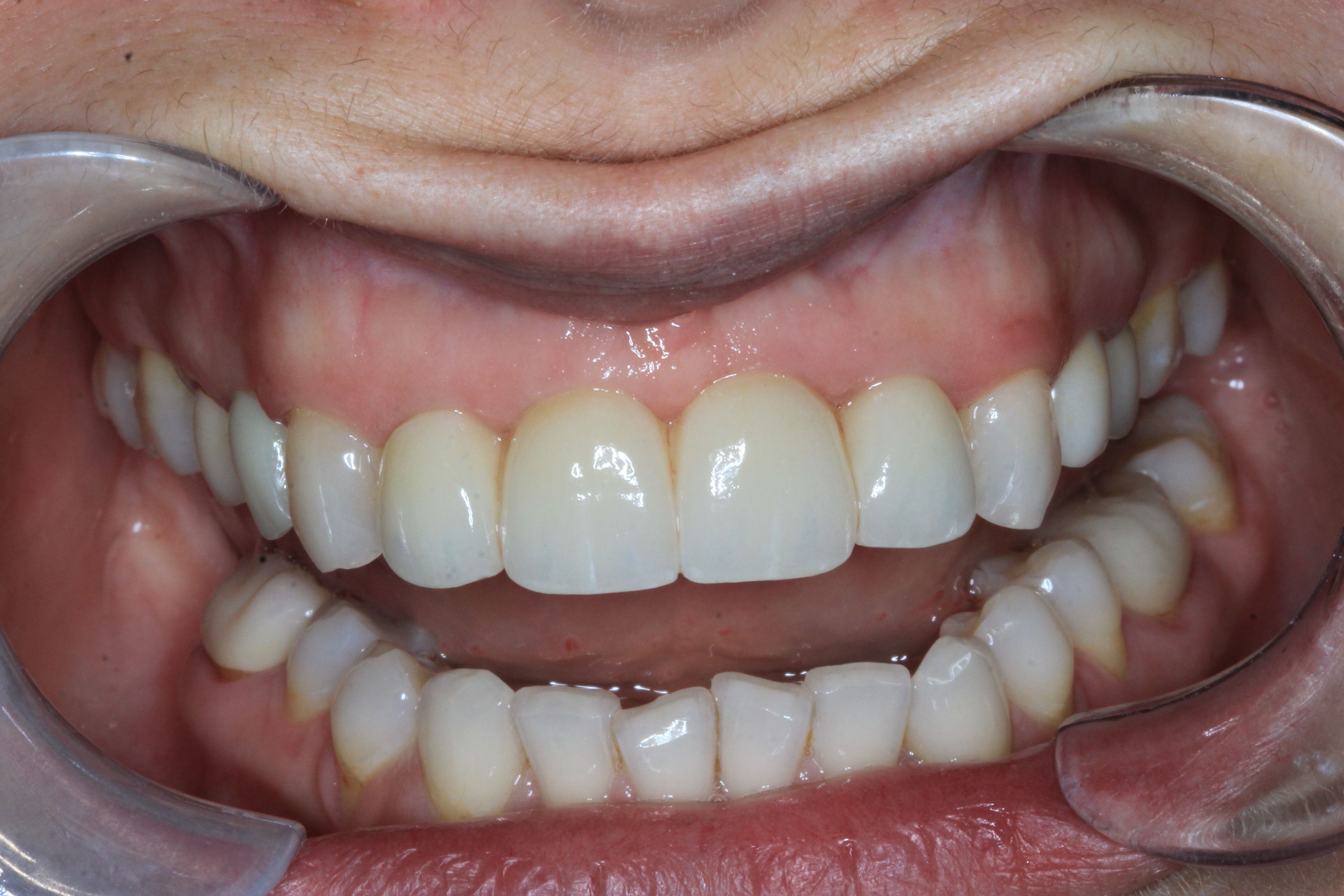 Dental Bridge after