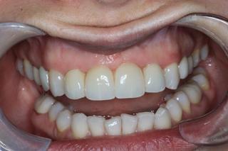 Dental Bridge after