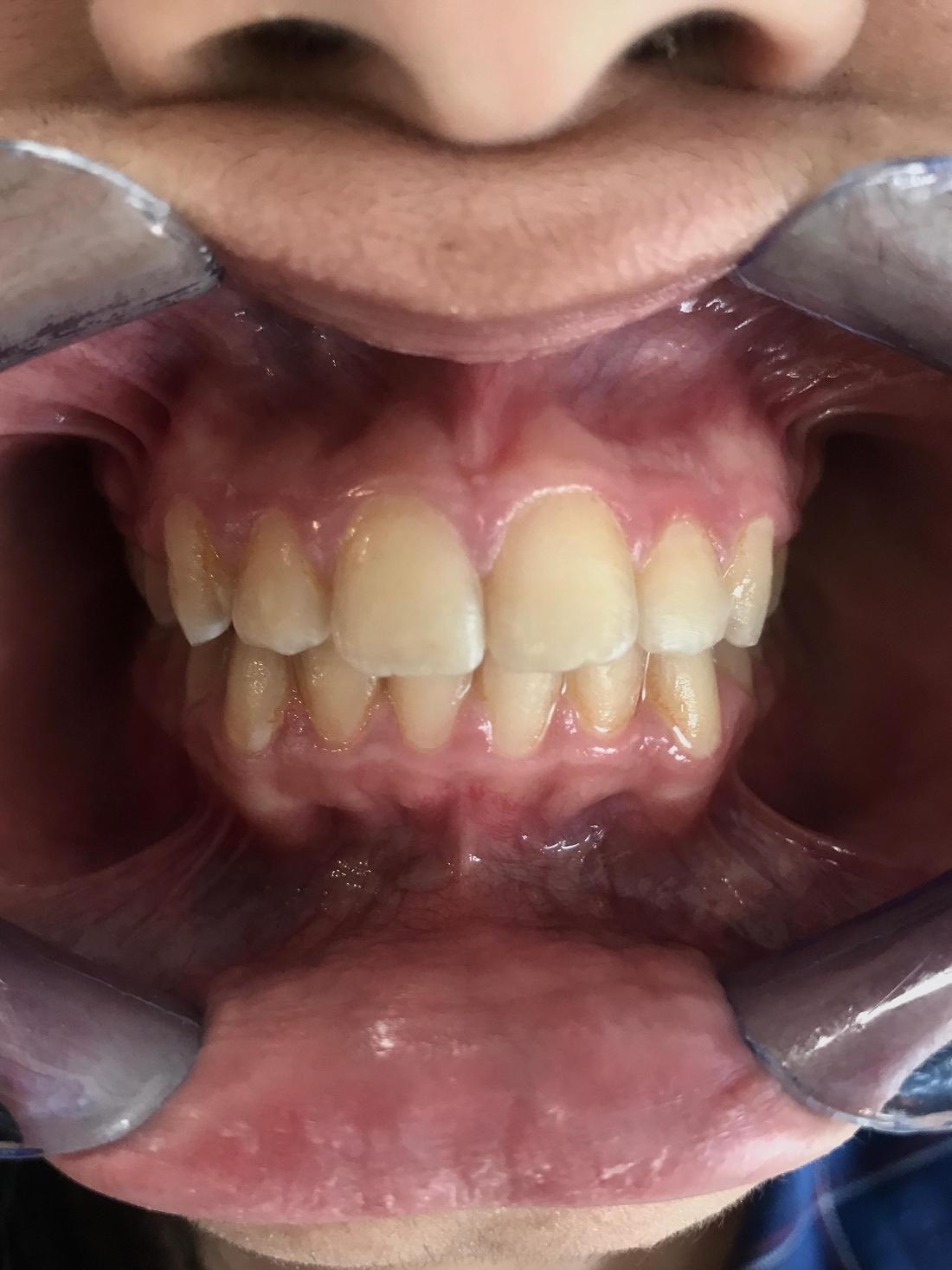 Braces and Invisalign - After