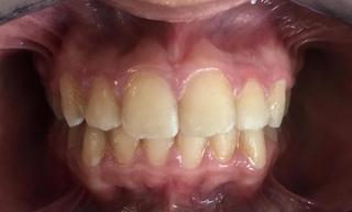 Braces and Invisalign - After