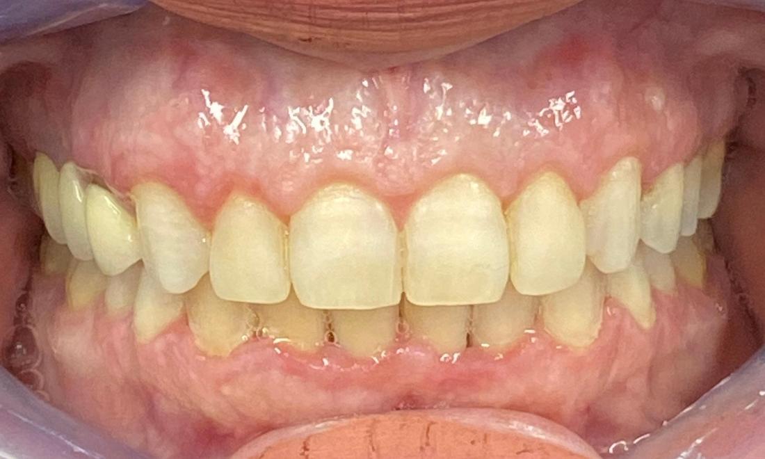 Braces and Invisalign -After