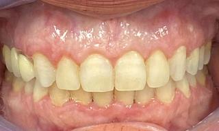 Braces and Invisalign -After