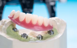 Closeup on implant retained denture