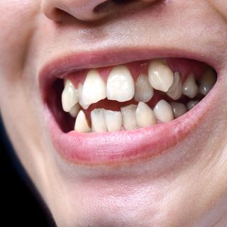 Image of a person with crowded teeth.