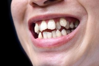 Am I Eligible for Invisalign?