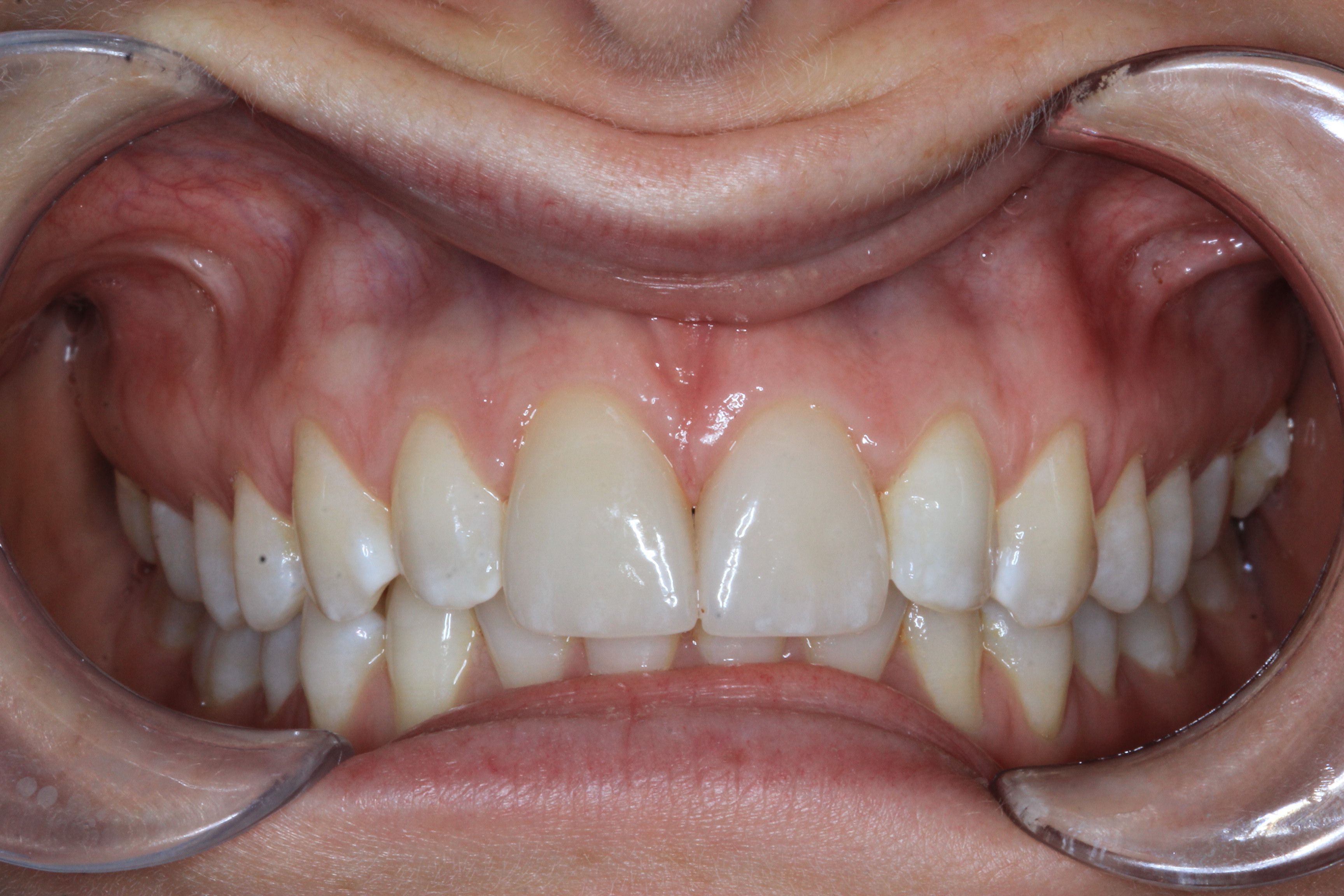 Crown and Veneer after