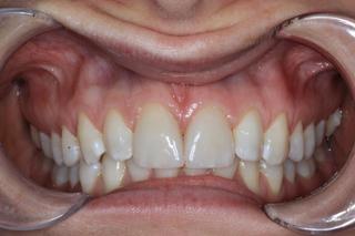Crown and Veneer after