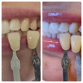 Female who struggled with yellow teeth. In-chair teeth whitening that got her from shade A2/A3 to lighter than B1!