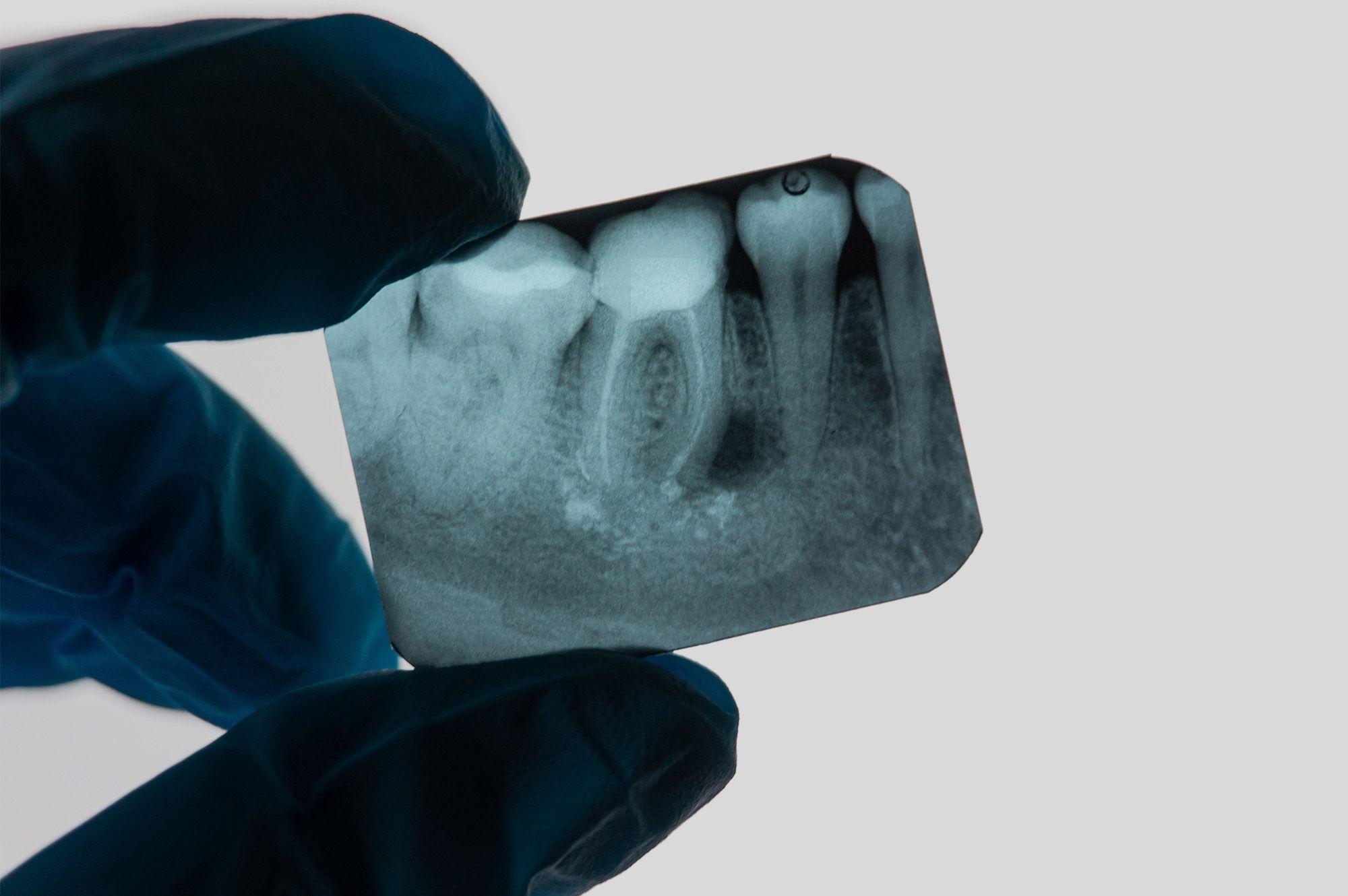 Endodontics (Root Canals)