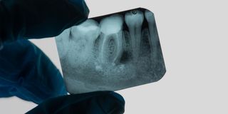 Endodontics (Root Canals)