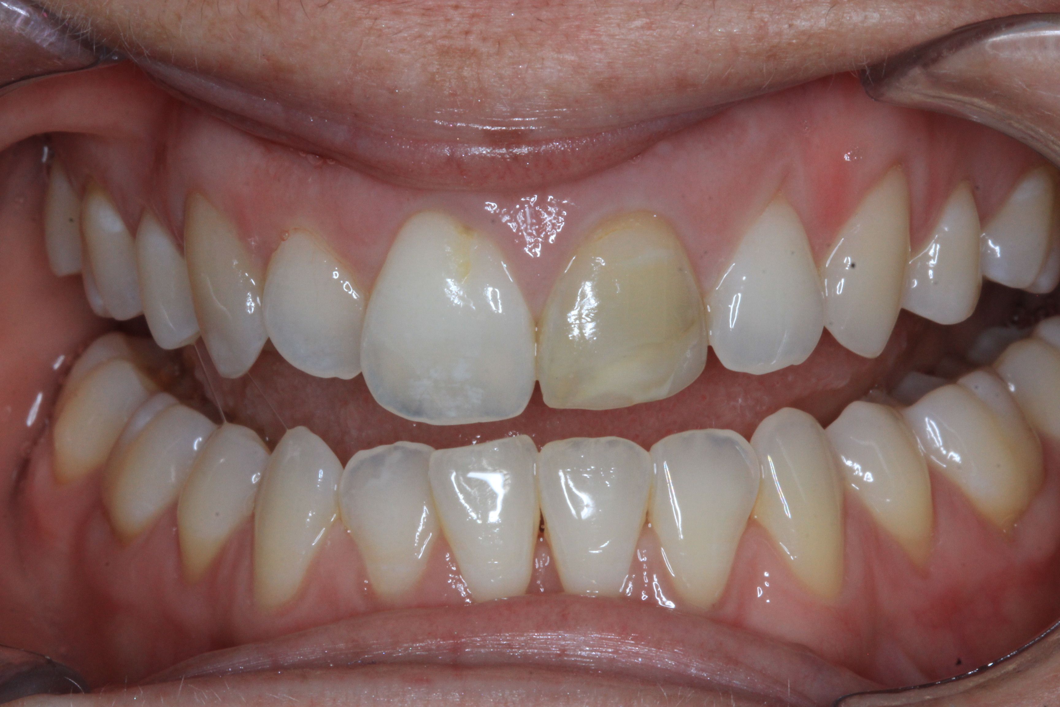 Crown and veneers to fix discoloured and uneven teeth before