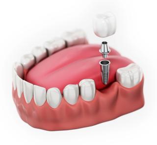 Single and Multiple Implants