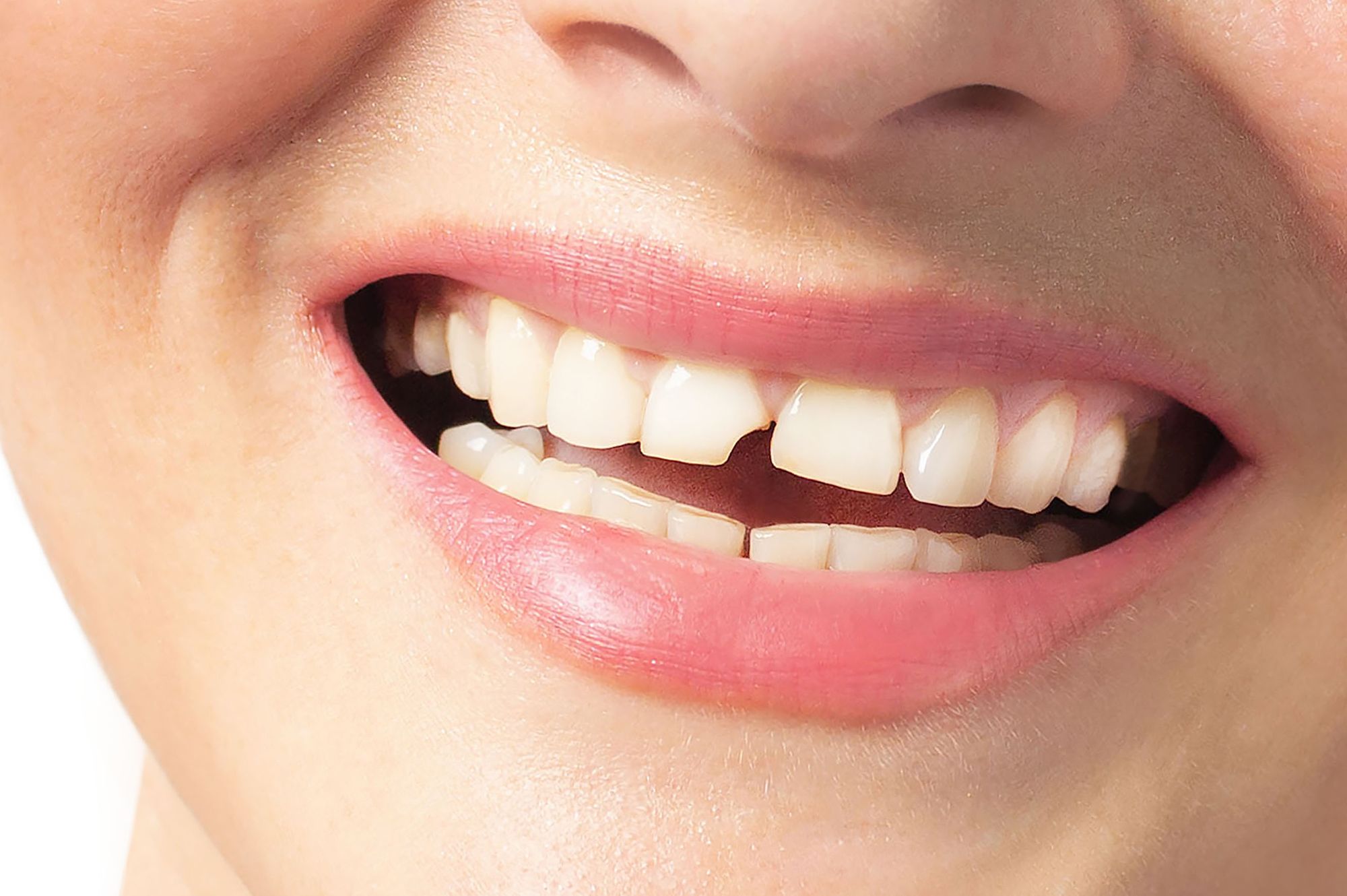 When Does a Tooth Need to Be Removed?