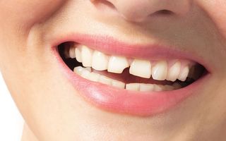 Broken Teeth