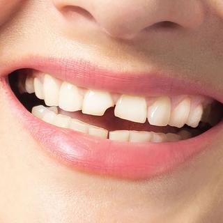 When Does a Tooth Need to Be Removed?