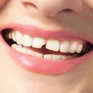 Dental abscess or swelling