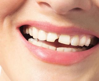 Cracked/fractured teeth