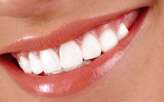 Female patient's teeth after a take home tooth whitening treatment