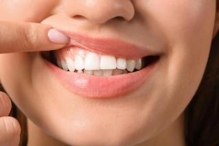 Gum Lift & Contouring at Wyndham Dental Solutions