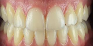 Before dental veneer