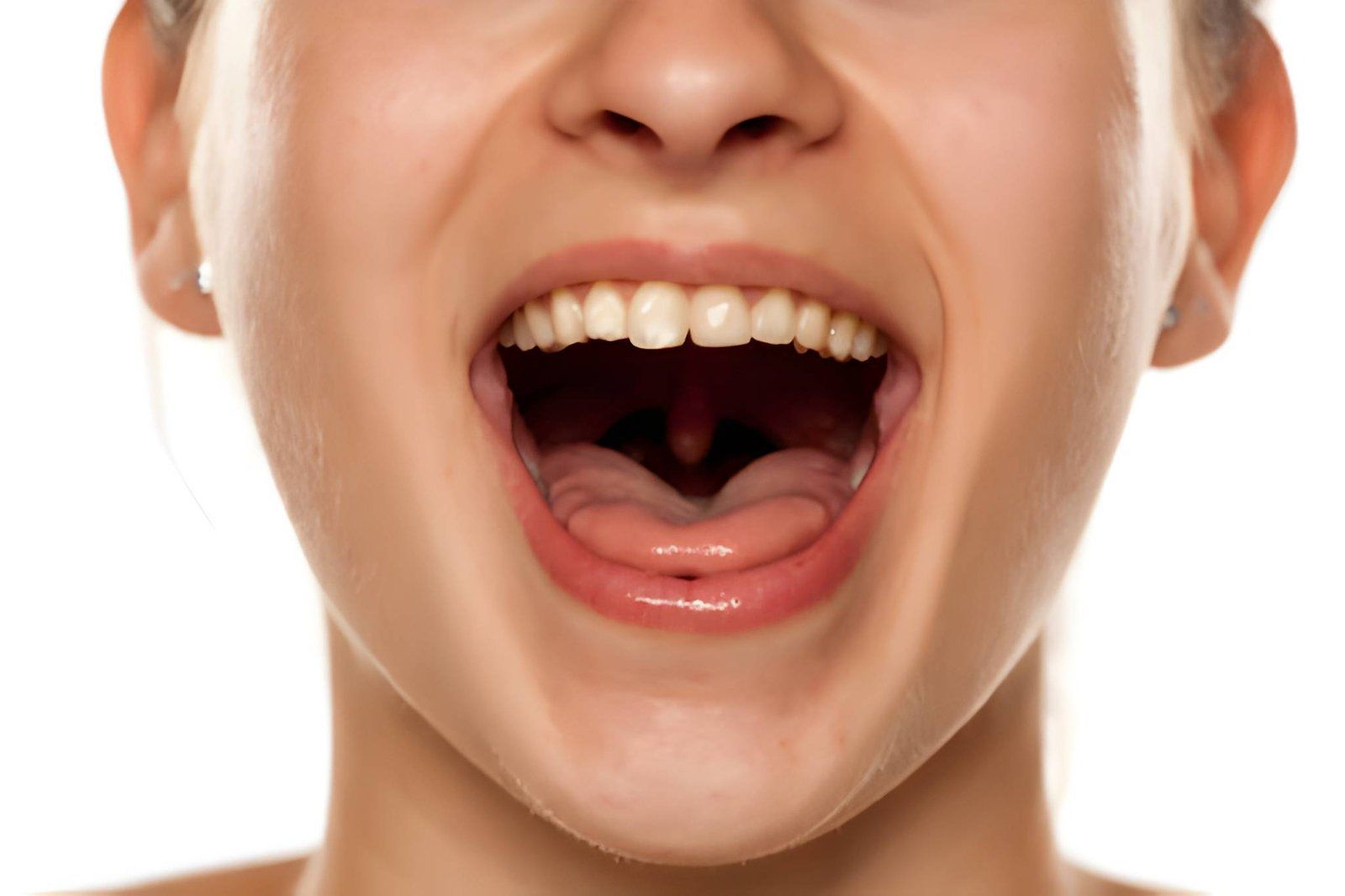 Dry mouth