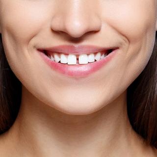 What Can Veneers Improve?