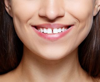 What Are Veneers?