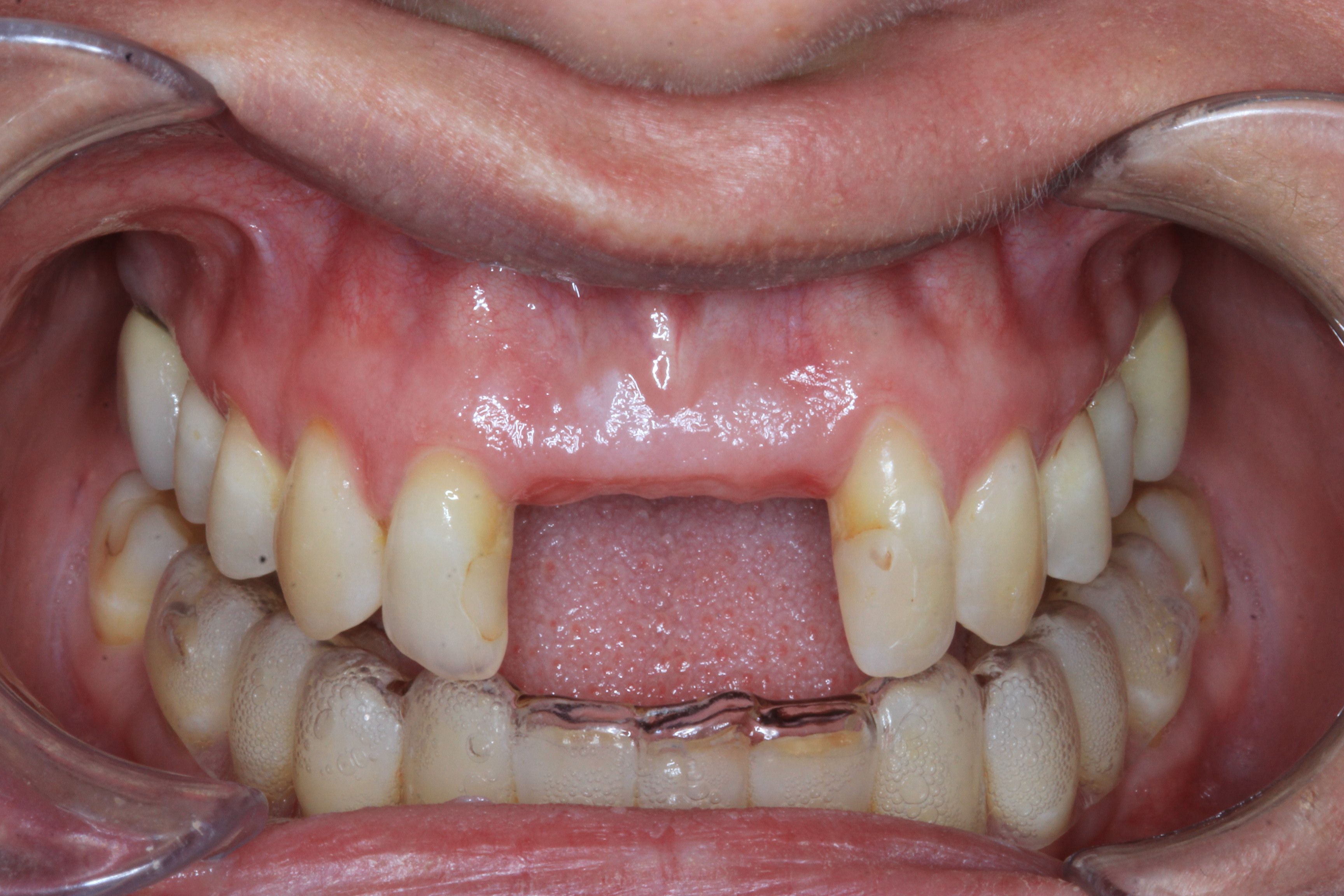 Orthodontics, Root Coverage Gum Grafting and Implants before