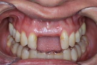 Orthodontics, Root Coverage Gum Grafting and Implants before