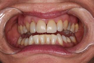 Dental Crowns 3 - Before
