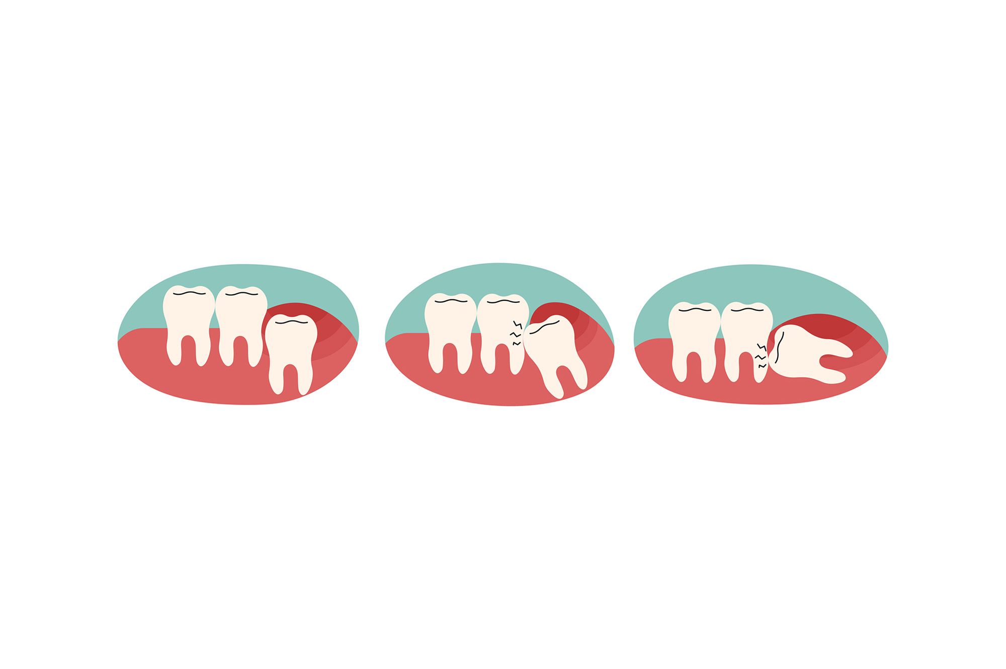 When Your Wisdom Teeth Need to Be Extracted?