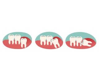 When Your Wisdom Teeth Need to Be Extracted?