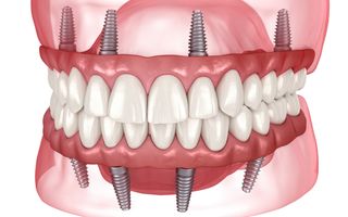 All-On-4 Dental Implants