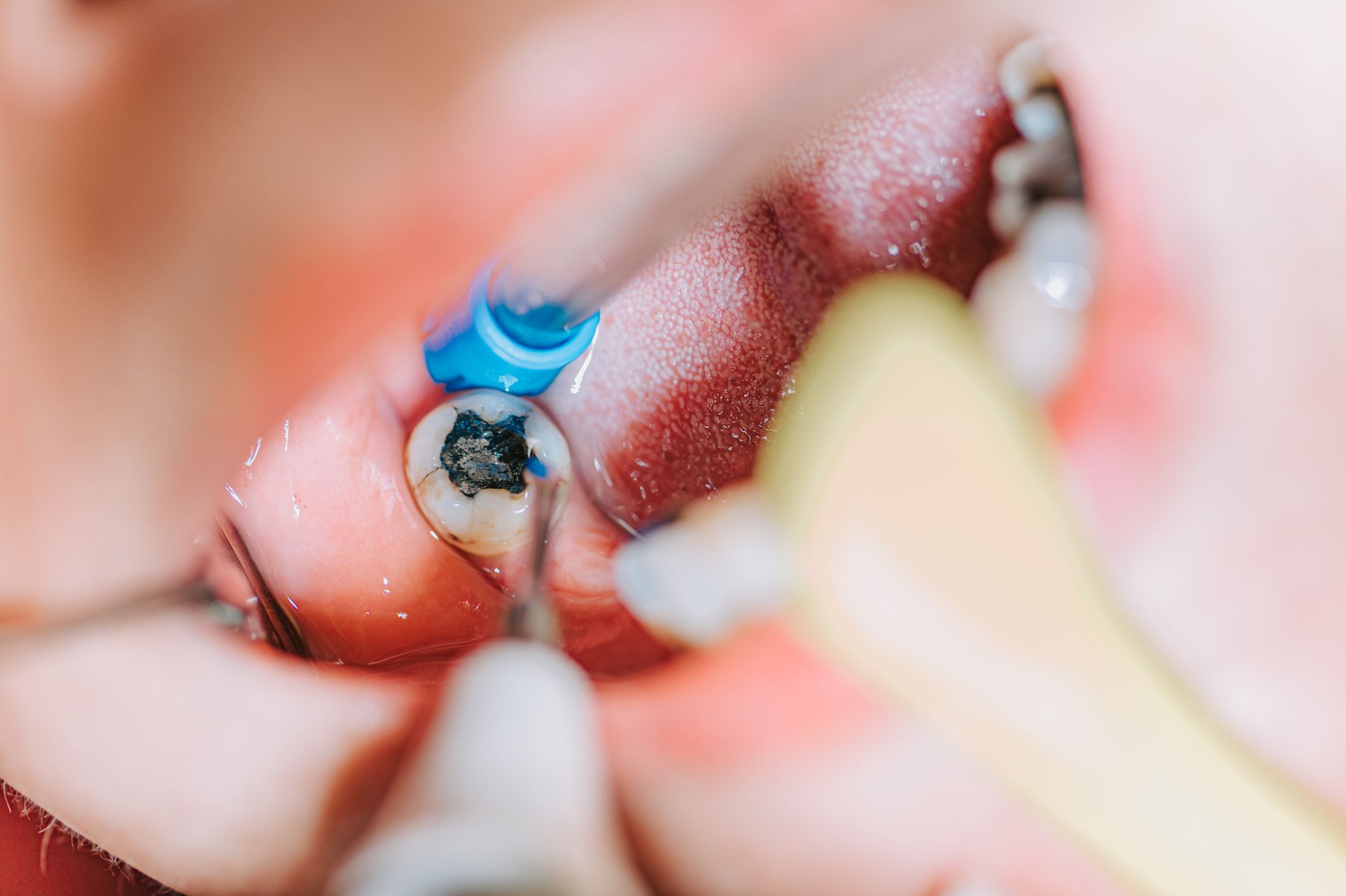 One of the most prevalent issues is tooth decay