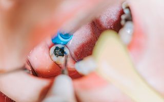Mouth with a cavity