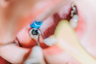 One of the most prevalent issues is tooth decay