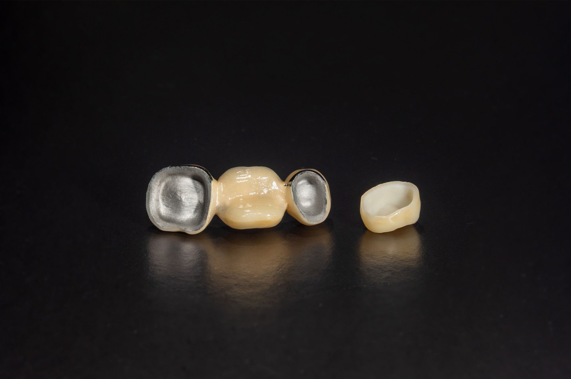 Porcelain Fused to Metal