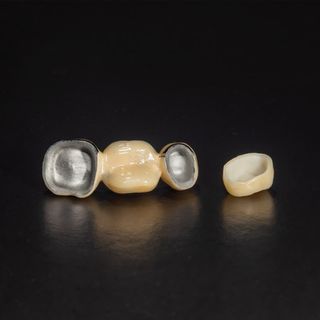 Porcelain Fused to Metal