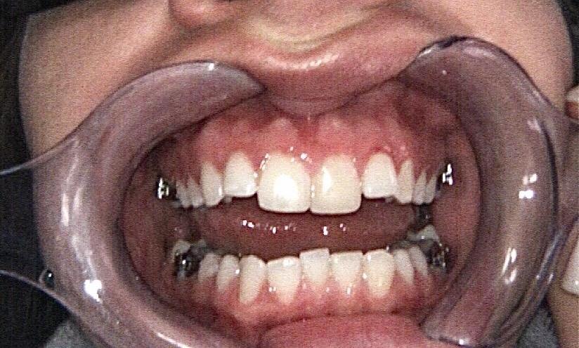 Braces and Invisalign - Before