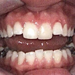 Braces and Invisalign - Before