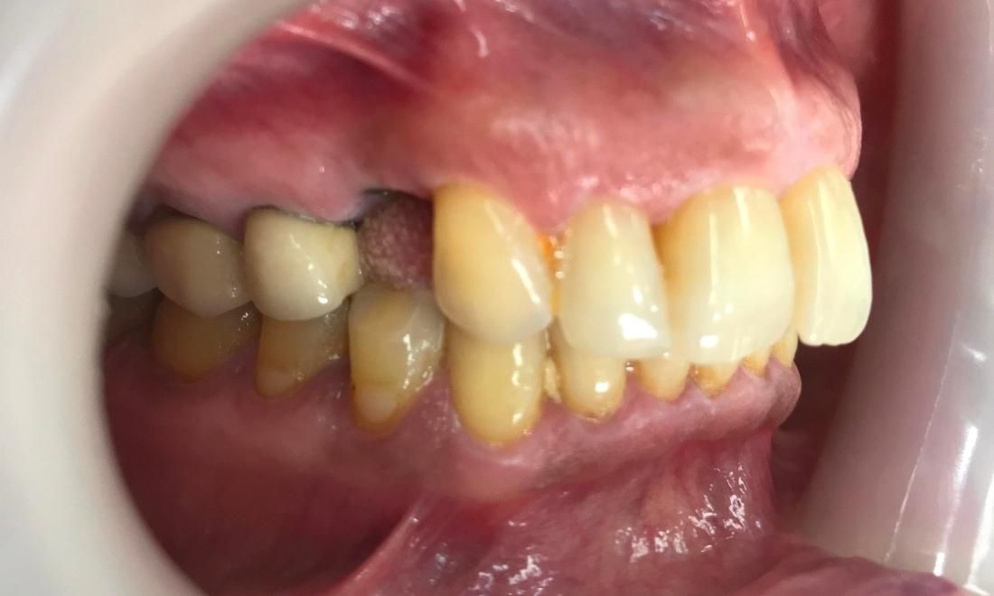 Dental Implants - Before - Left Side