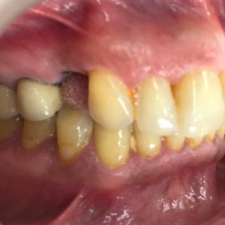 Dental Implants - Before - Left Side