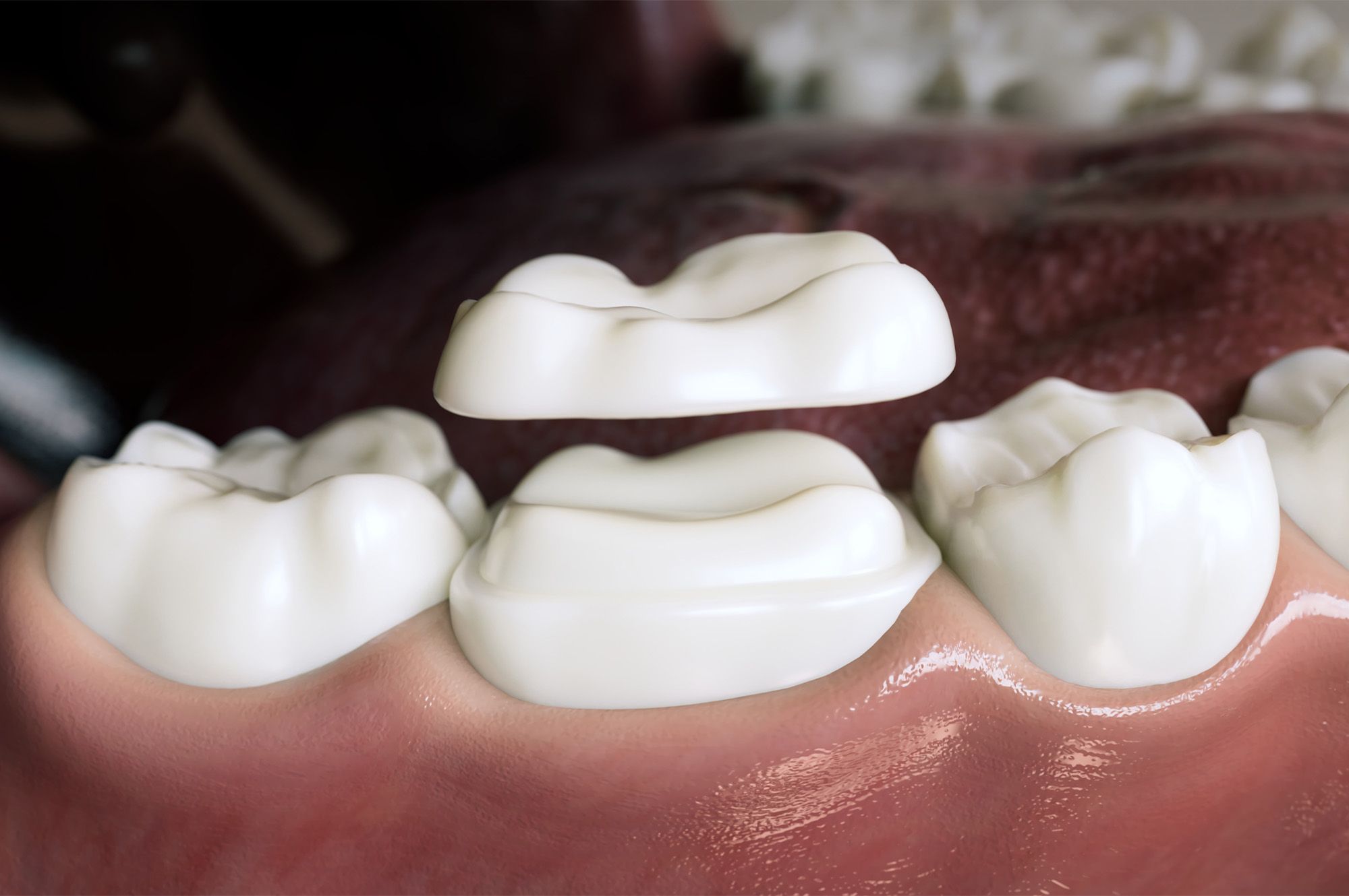 The Dental Crown Procedure