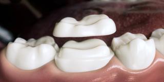 The Dental Crown Procedure