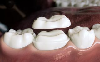 3D render of a dental crown being placed on a tooth within a mouth.
